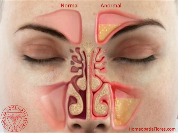 Efectividad de la homeopatía en sinusitis crónica